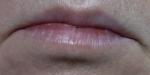 Отёчность нижней губы фото 2