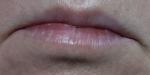 Отёчность нижней губы фото 1