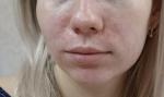 Себорейный дерматит на лице, как лечить? фото 1