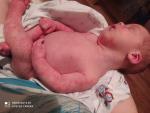 Аллергия на белок, сыпь у новорождённого фото 1