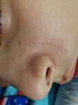 Сыпь на носу у ребенка фото 5