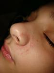Сыпь на носу у ребенка фото 4