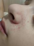 Сыпь на носу у ребенка фото 3