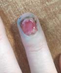 Рана после удаления ногтевой пластины фото 1