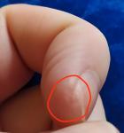 Белое, болезненное уплотнение возле ногтя фото 2