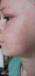 Срочно: аллергия: сыпь и припухлость на лице и руках фото 1