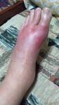 Отек ступни с воспалением сустава большого пальца фото 2