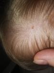 Коричневое пятнышко на голове у ребёнка 2 лет фото 5