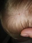 Коричневое пятнышко на голове у ребёнка 2 лет фото 4