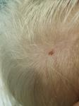 Коричневое пятнышко на голове у ребёнка 2 лет фото 2