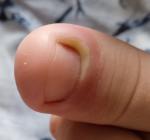 Опухло возле ногтя большого пальца фото 2