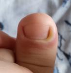 Опухло возле ногтя большого пальца фото 1