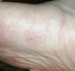Бежевые наросты, красные точки и шелушение на пальце и стопе фото 2