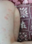 Аллергия у ребенка 3 лет на ногах фото 3