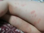 Аллергия у ребенка 3 лет на ногах фото 1