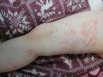 Аллергия у ребенка 3 лет на ногах фото 2