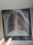 Рентген органов грудной клетки фото 2