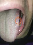 Белое пятно на языке после травмы фото 3