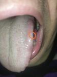 Белое пятно на языке после травмы фото 2
