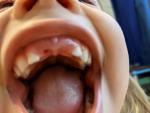Выпали передние зубки у ребенка когда ждать коренные? фото 2