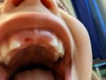 Выпали передние зубки у ребенка когда ждать коренные? фото 1