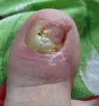 Ноготь и кожа на большом пальце ноги фото 1