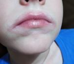 Воспаление кожи вокруг рта (с фото) фото 1
