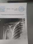 Остеопороз плечевого сустава артрит артроз боль в плече рентген результат фото 1