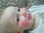 Аллергические ские реакции непонятного происхождения у ребенка фото 1