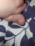 Пузырьки на пальце ног. Что это может такое быть? фото 1