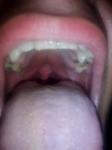 Боль в горле, белый язык фото 3