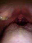Боль в горле, белый язык фото 2