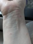 Сыпь на коже рук и ног фото 5