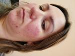 Покрамнение кожи лица. Воспаление и высыпание фото 3
