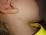 Аллергия или кожное заболевание фото 1