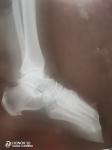 Перелом ноги, нога в гипсе фото 3