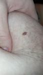 Пигментный невус на груди фото 1