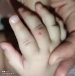 Красная шишка на пальце руки ребенка фото 1