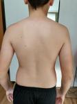 Деформация грудной клетки и спины фото 3