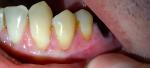 Странные пятна внизу зуба фото 4