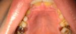 Странные пятна внизу зуба фото 3