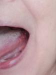 Ком в горле, воспаление на языке, боль в глотке, фото 2