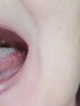 Ком в горле, воспаление на языке, боль в глотке, фото 1