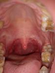 Разрастание лимфоидной ткани в горле фото 4