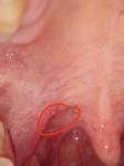 Разрастание лимфоидной ткани в горле фото 2