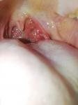 Боль в горле, белый налет на миндалинах фото 2
