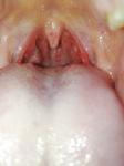 Боль в горле, белый налет на миндалинах фото 1