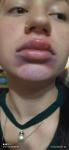 Отёк губ, синий подбородок, герпес, аллергия фото 1