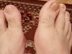 Боль в большом пальце ноги фото 2