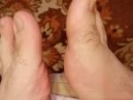 Боль в большом пальце ноги фото 3